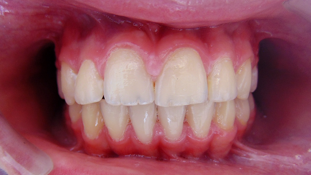 Фото зубов после брекет-системы