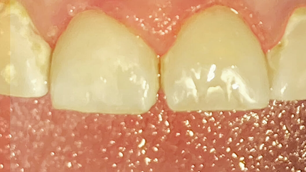 Зубы после лечения кариеса дентина