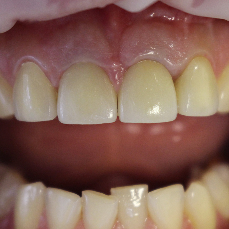 Фото зубов с коронками 2 