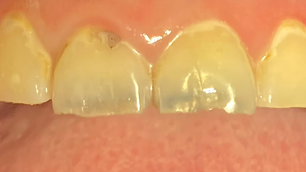 Зубы до лечения кариеса дентина