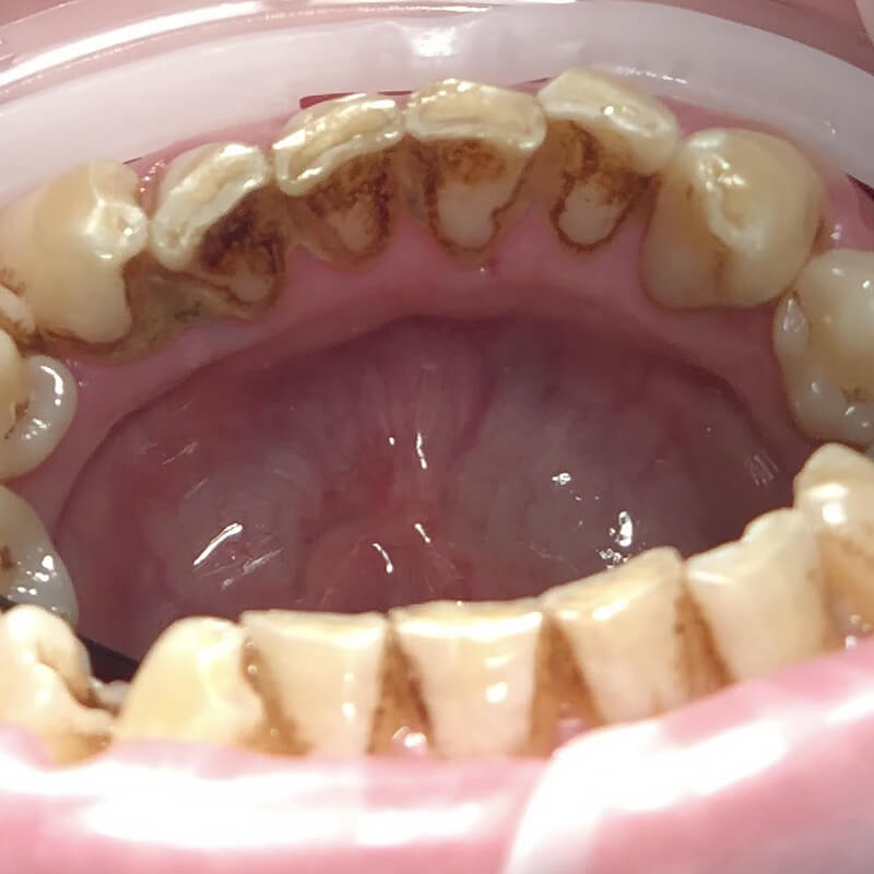 Фото зубов до проведения гигиены