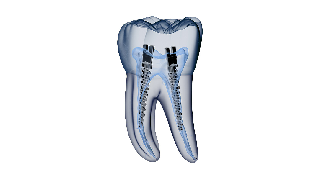 Основные признаки и причины отторжения зубного импланта