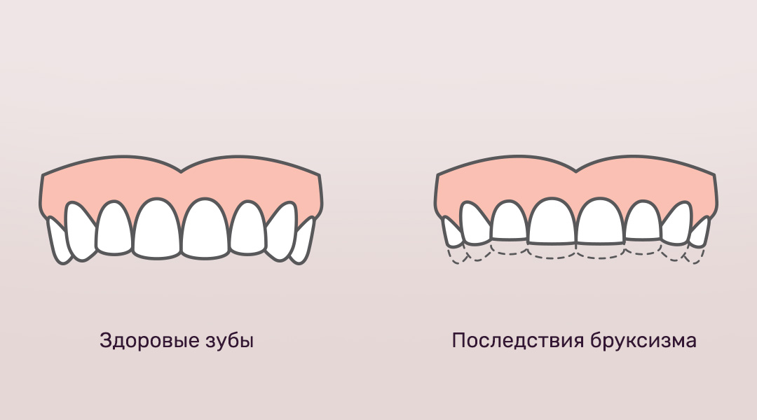 Как стачиваются зубы при бруксизме