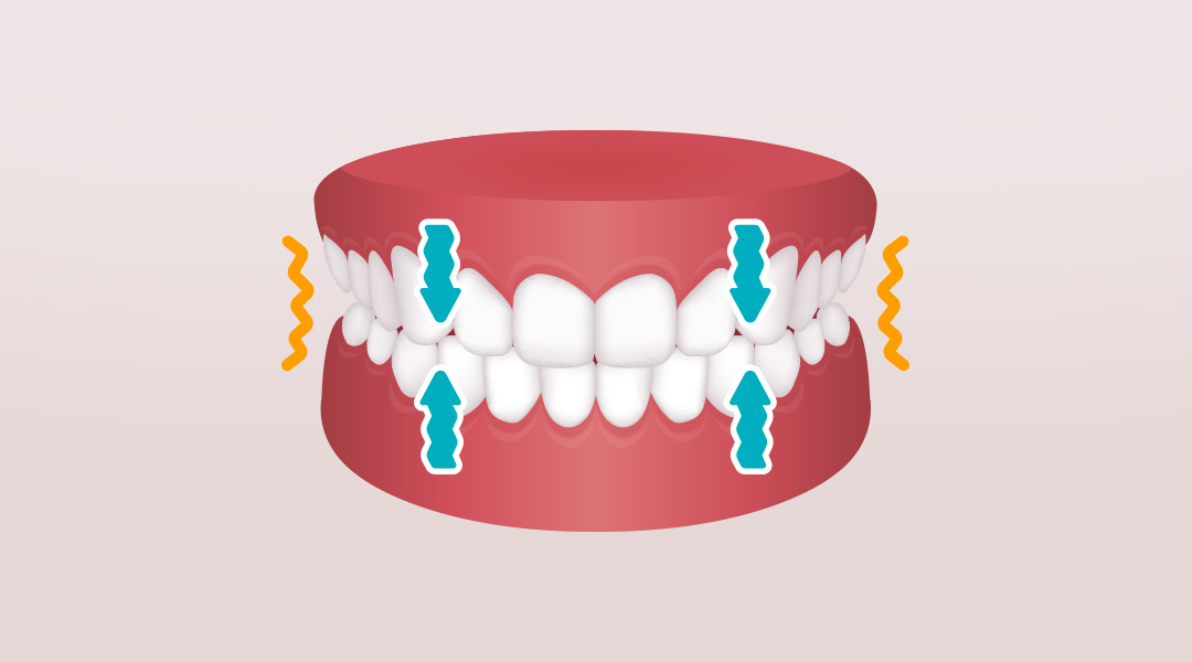 Как бруксизм воздействует на зубы