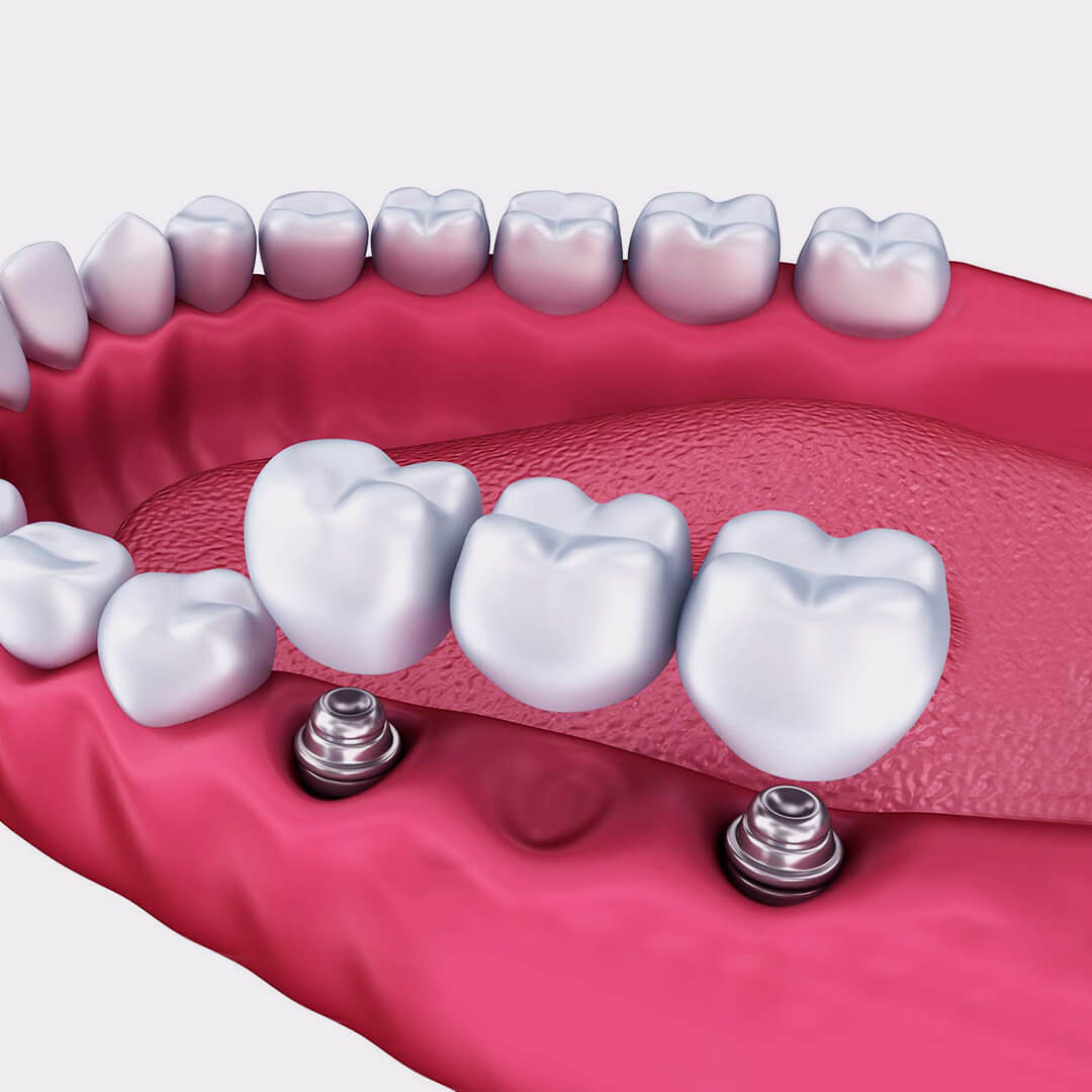 Импланты передних зубов фото