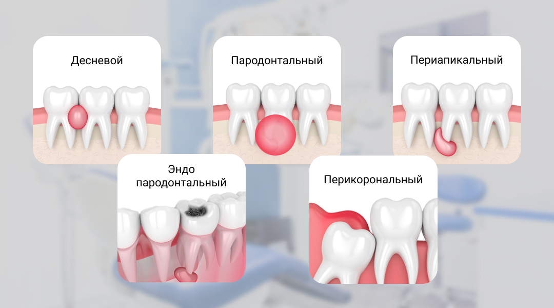 Коллаж вариантов абсцесса зуба