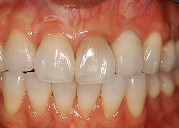 фотография передних зубов после имплантации