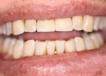 фото зубов пациента после вживления двух имплантов