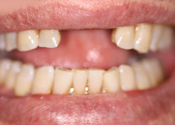 фотография зубов пациента перед имплантацией