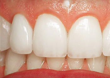 Фотография после имплантации 12 зуба