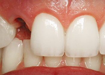 Фото передних зубов до имплантации 12 зуба