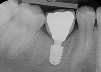 снимок зуба после имплантации в области 46 единицы