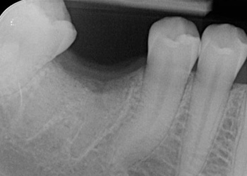 рентген области 46 зуба до имплантации