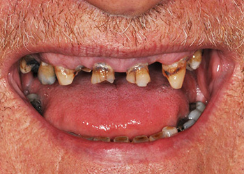фото зубов пациента до частичного протезирования