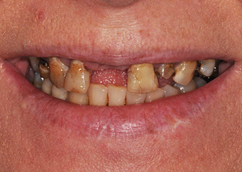 фотография зубов пациентки до протезирования