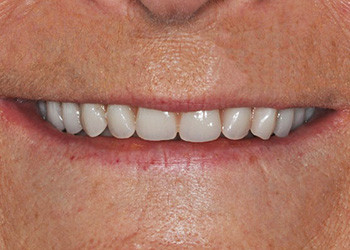 фото улыбки после протезирования верхней челюсти