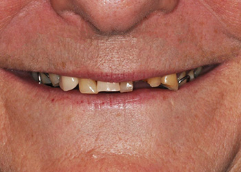 фотография зубов пациента до протезирования