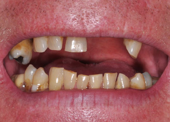 фото зубов до полного съёмного протезирования