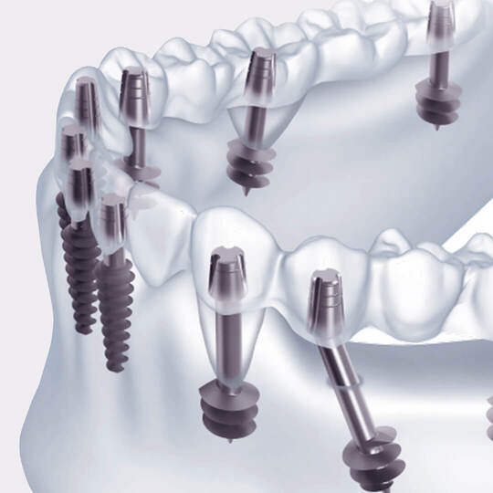 быстрое восстановление зубов одноэтапной базальной имплантацией