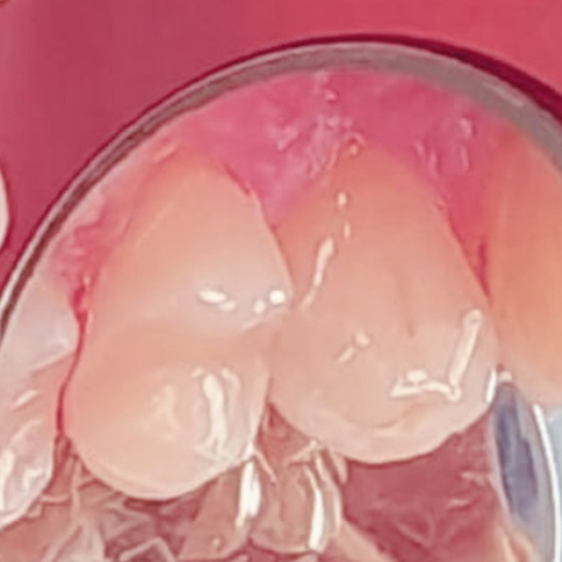 фотография зубов после лечения хронического среднего кариеса