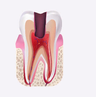 изображение зубной единице в разрезе с поражённой пульпой