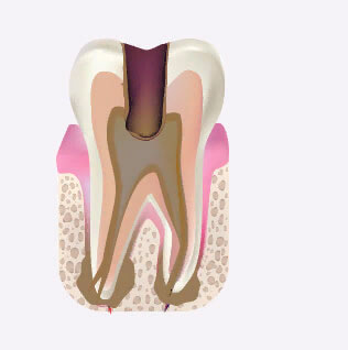 изображение пораженного зуба и околозубных тканей периодонтитом