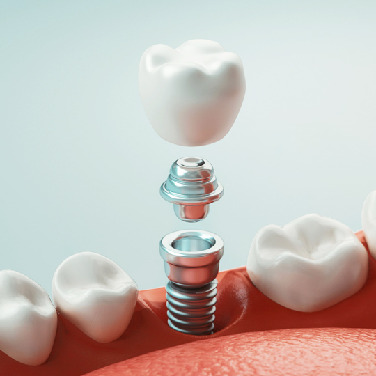 изображение зубного импланта в разобранном виде
