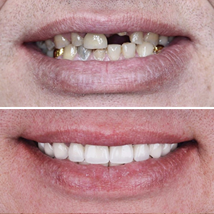 реставрация зубов верхней и нижней челюсти композитными винирами