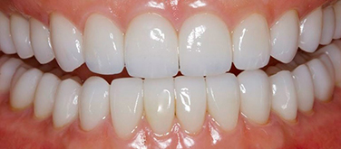 фотография зубов с лицевой стороны после протезирования