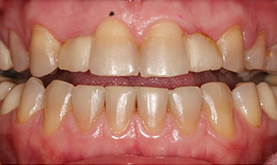 фотография зубов до протезирования винирами