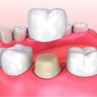 Схематичное изображение установки зубной коронки