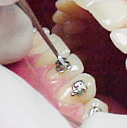 фотография фиксации металлических скоб на зубы