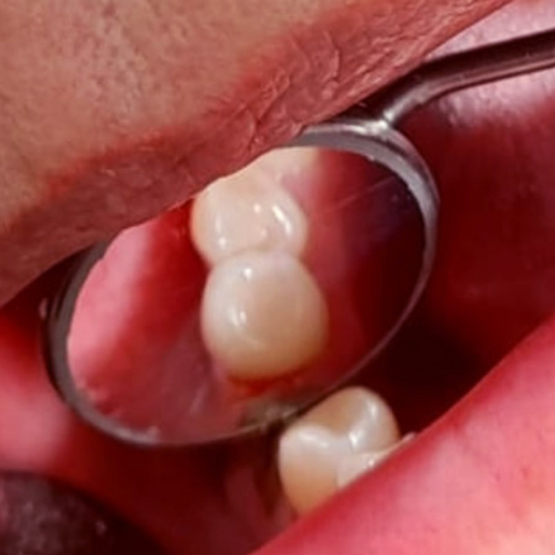 фотография здорового зуба после лечения периодонтита