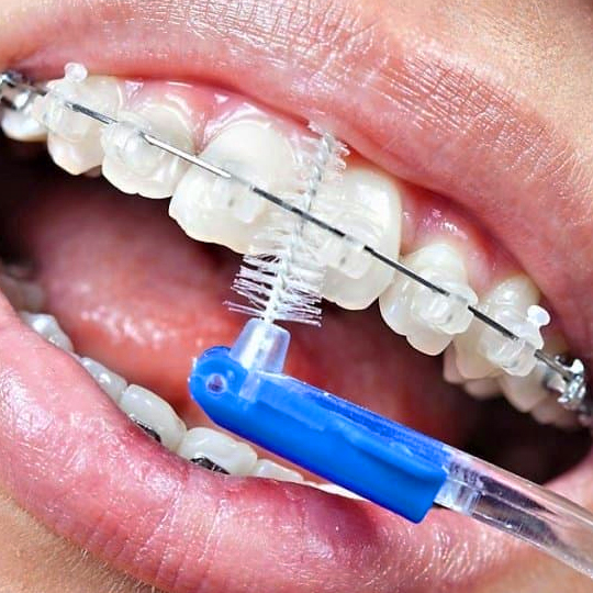 фото в процессе чистки зубов и брекетов