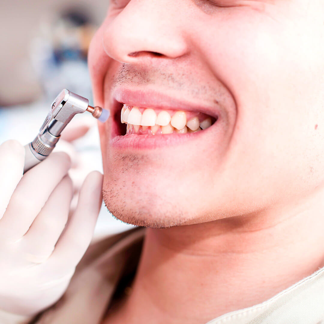 процесс профессиональной чистки зубов
