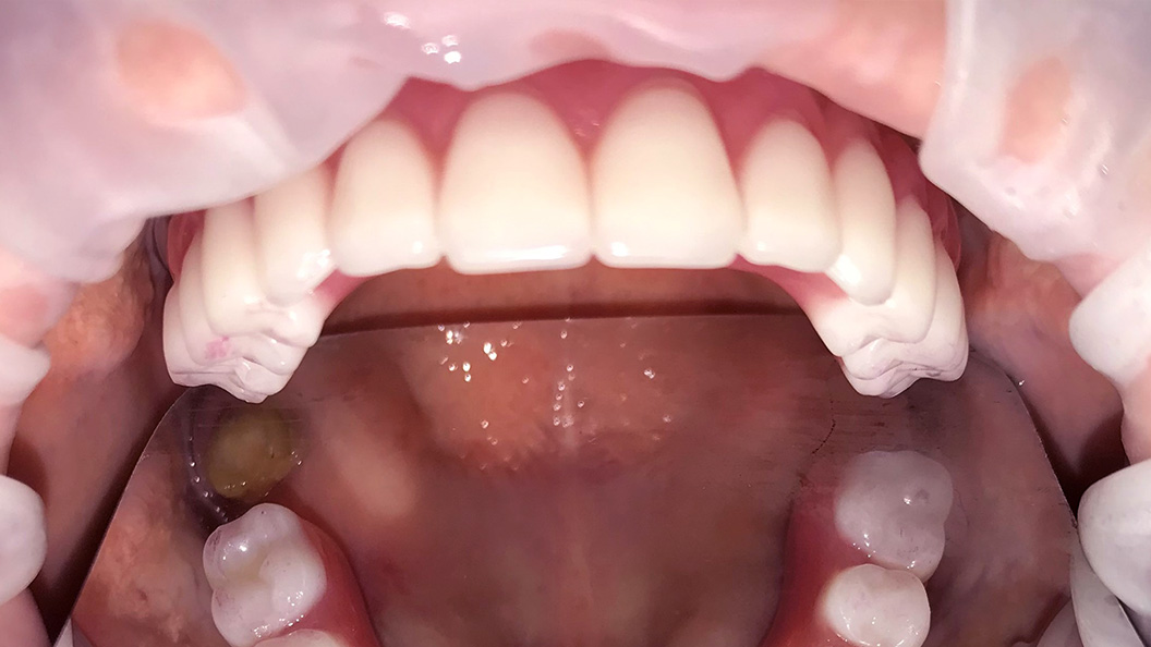Зубы после восстановления