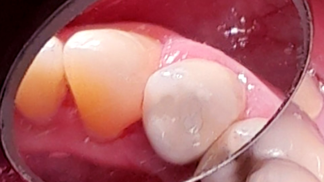 Вылеченный зуб