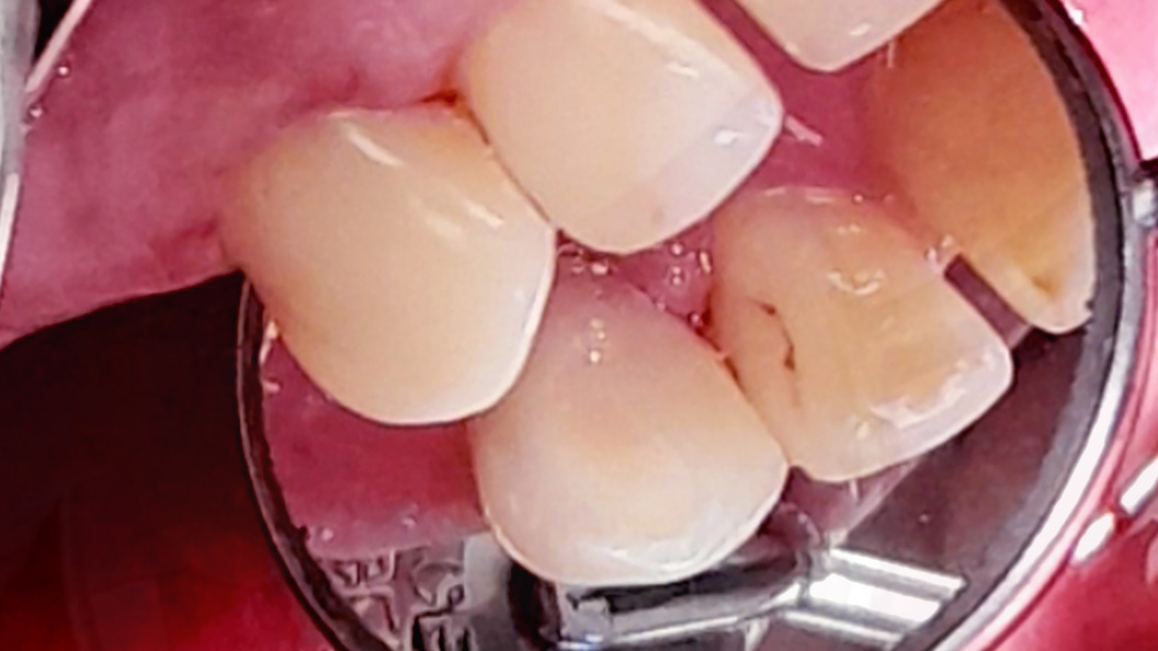 Фото зуба после лечения фиброзного пульпита