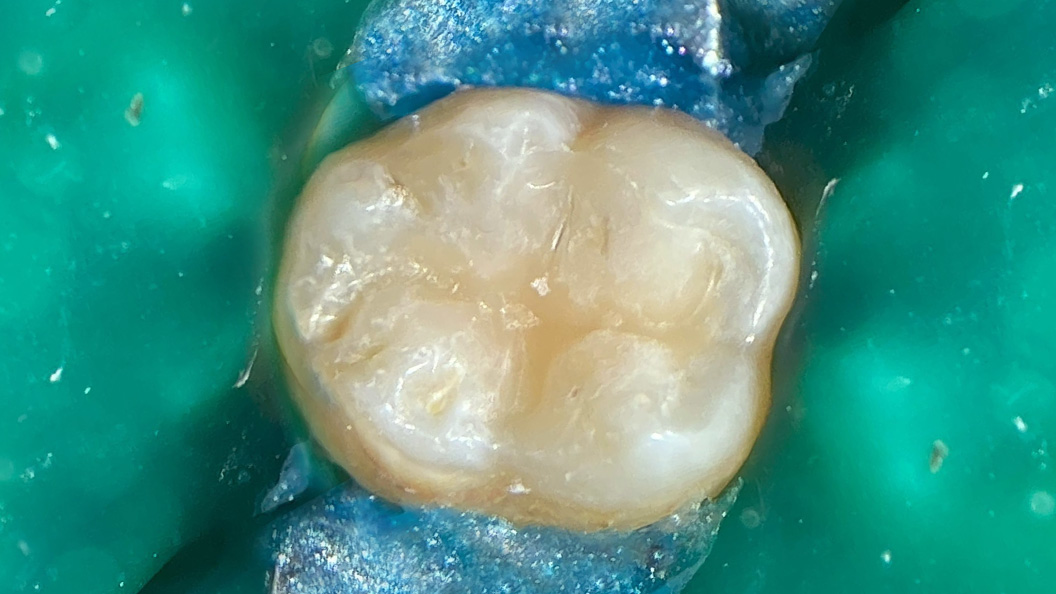 Фото зуба после лечения композитом