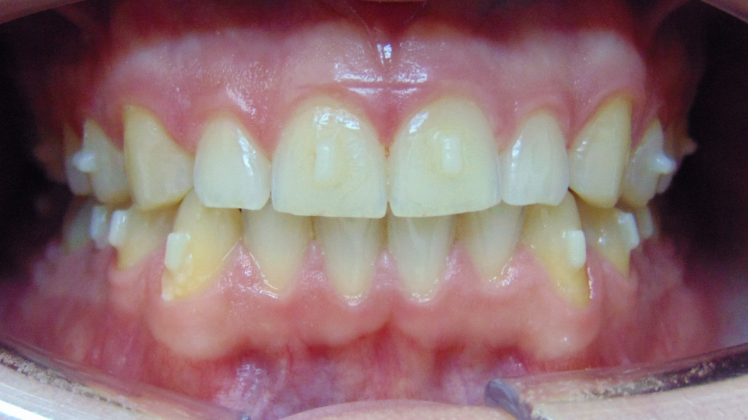Фото зубов после лечения на элайнерах