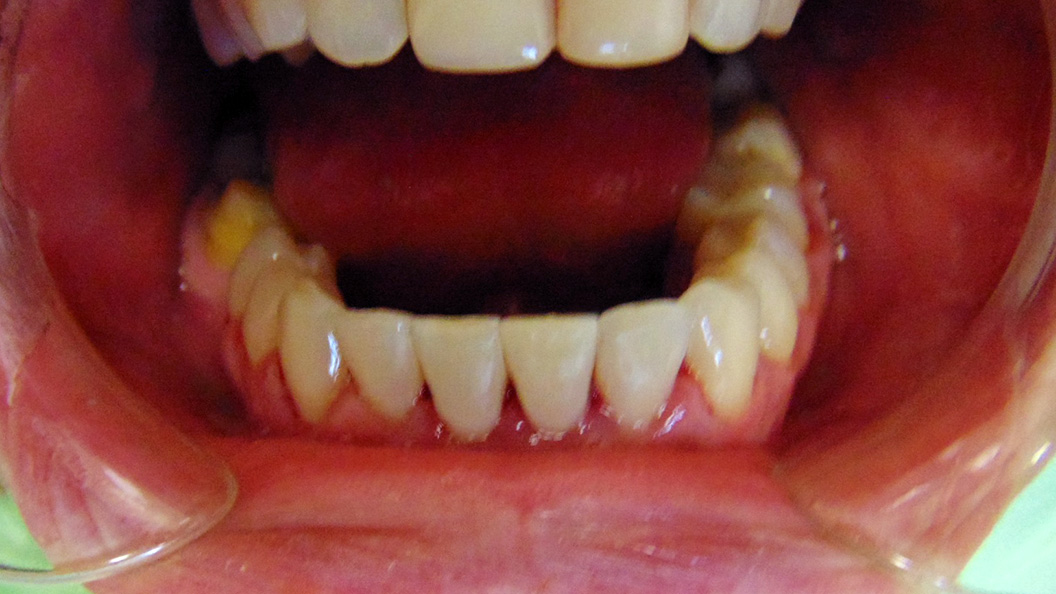 Фото после лечения скрученности зубов
