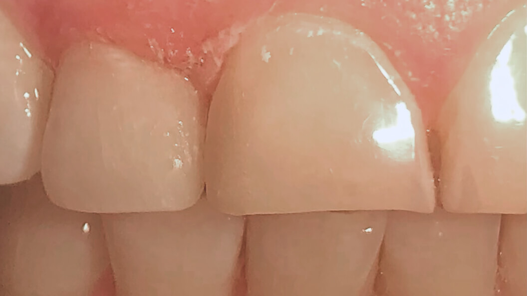 Фото зубов 1.2 и 1.1 после лечения