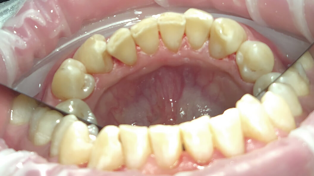 Фото зубов после проведения гигиены