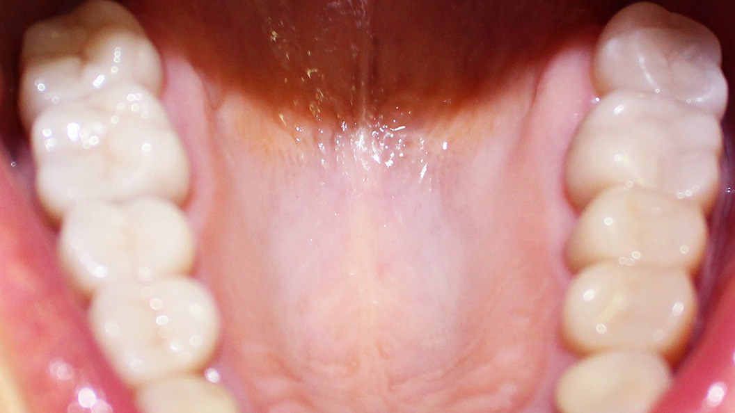 Фото установленных на зубы коронок