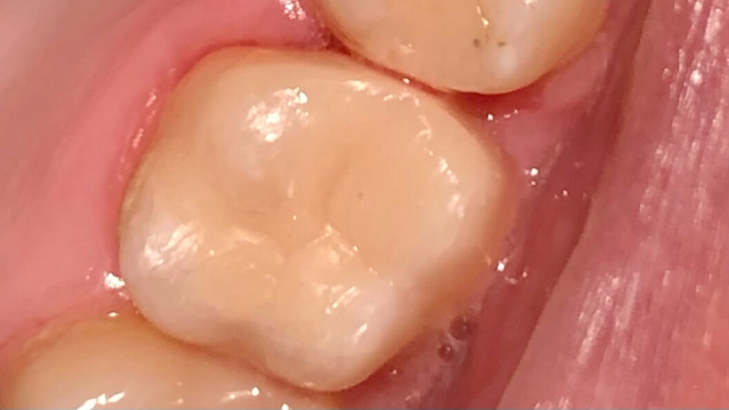 Фото зуба после лечения композитом