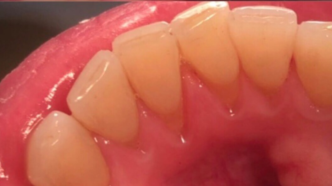 Фот зубов после гигиены