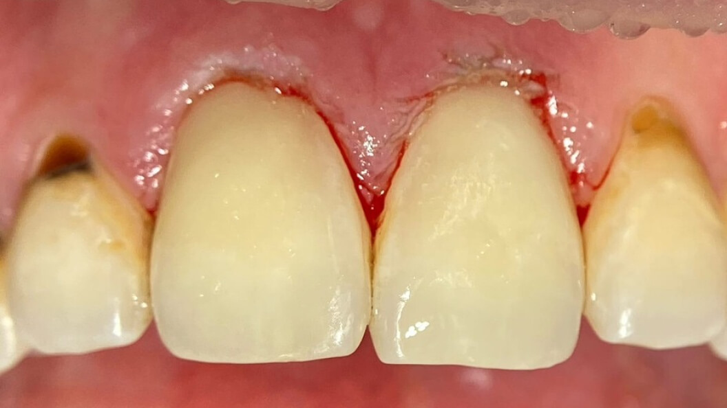 Фото зубов после лечения