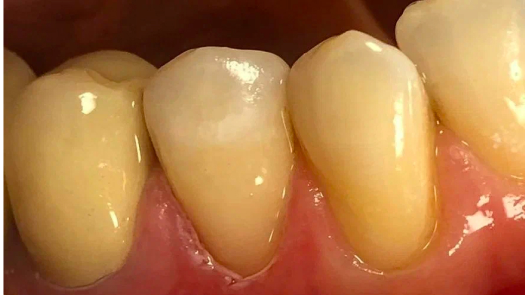 Фото зуба после лечения дефекта