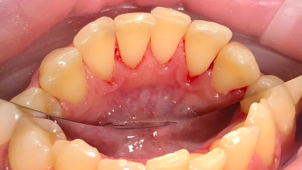Фото зубов после снятия отложений