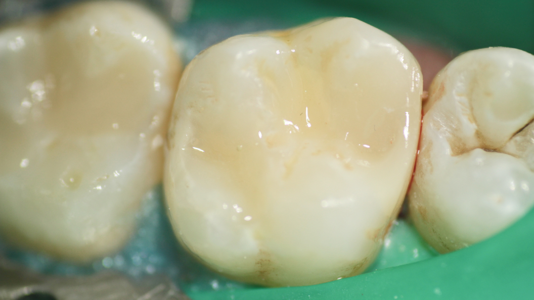 Фото зуба после лечения наногибридным композитом